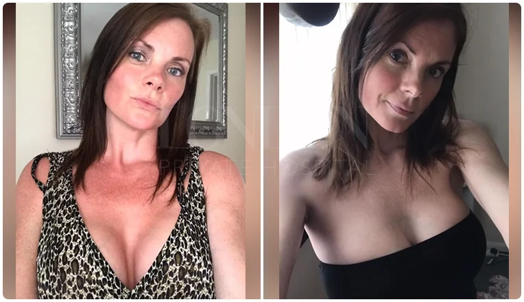 boob job before and after result patient-11