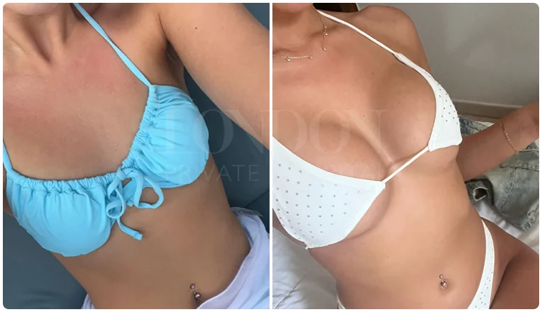 boob job before and after result patient-14