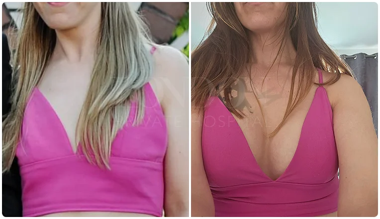 boob job before and after result patient-18