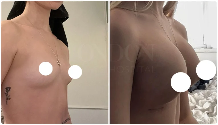 boob job before and after result patient-3-v1