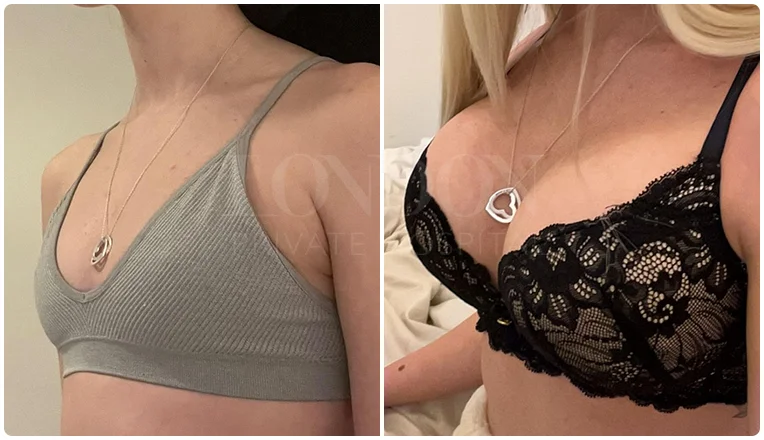 boob job before and after result patient-3-v2