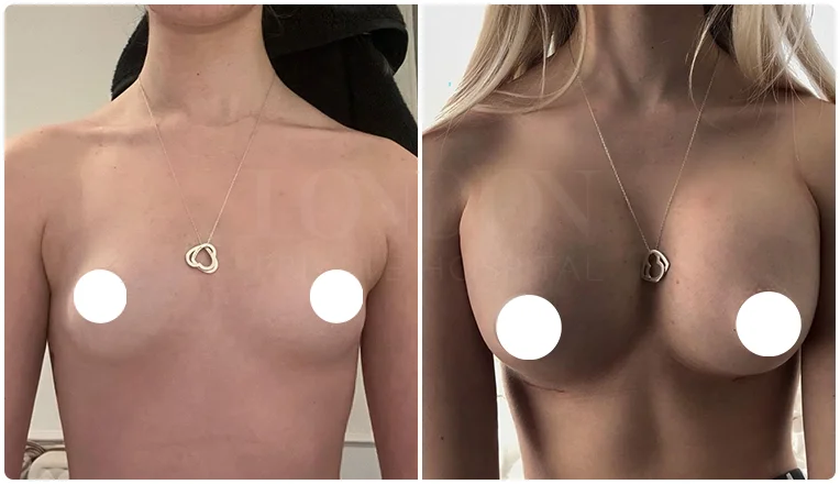 boob job before and after result patient-3