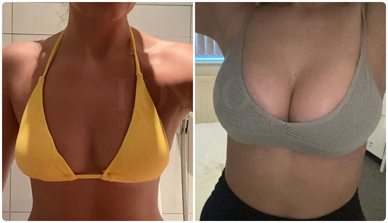 boob job before and after result patient-4