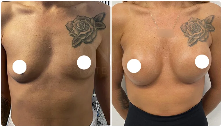 boob job before and after result patient-5