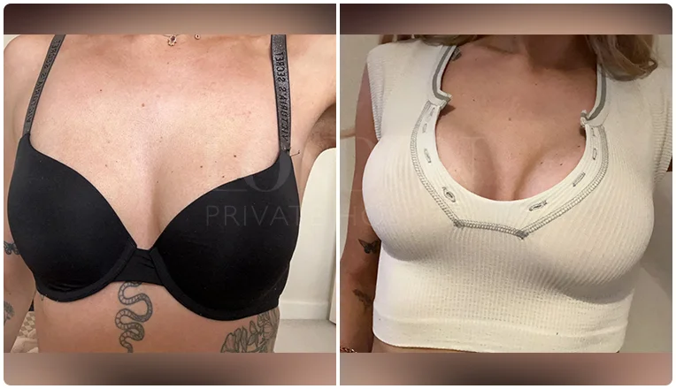 boob job before and after result patient-6