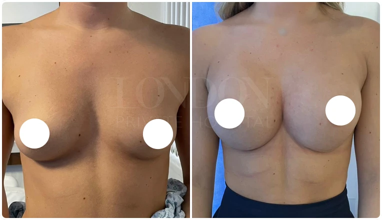 breast augmentation before and after patient-1