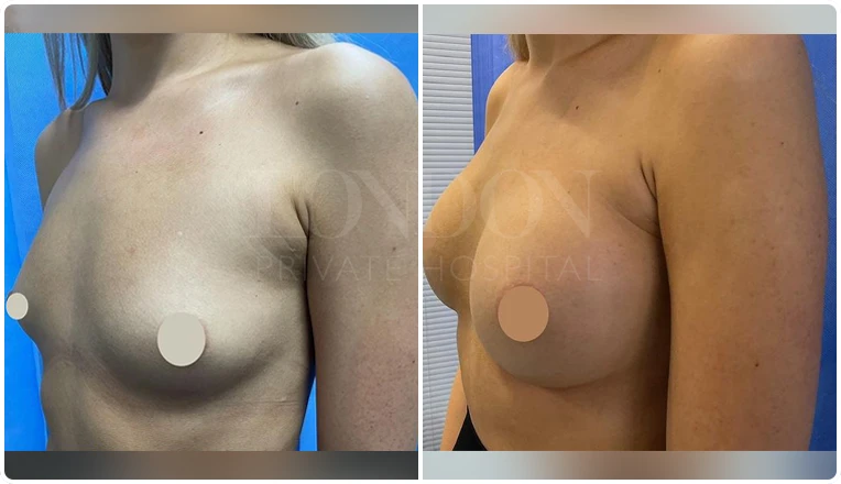 breast augmentation before and after patient-10-1