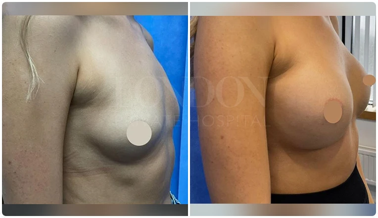 breast augmentation before and after patient-10