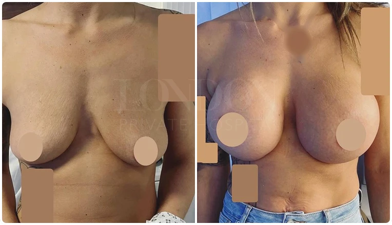 breast augmentation before and after patient-2