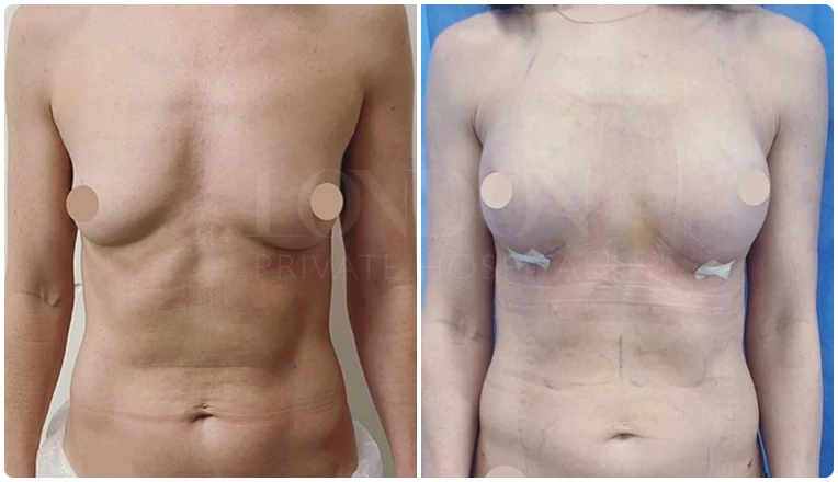 breast augmentation before and after patient-3