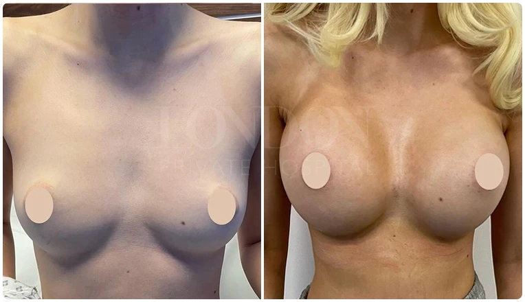 breast augmentation before and after patient-4