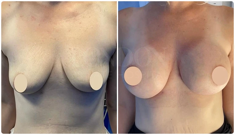 breast augmentation before and after patient-5