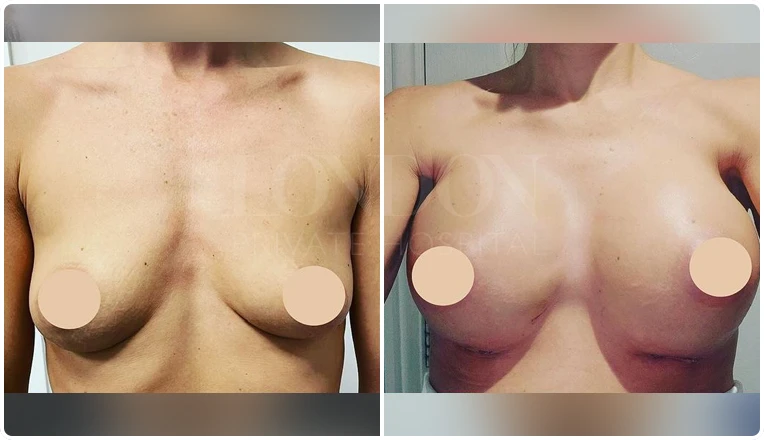 breast augmentation before and after patient-6