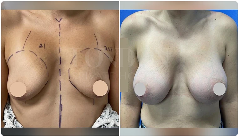 breast augmentation before and after patient-7