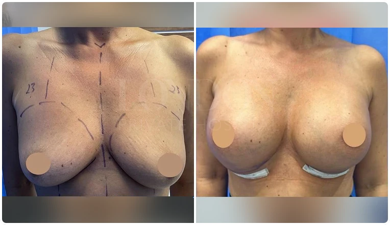 breast augmentation before and after patient-8