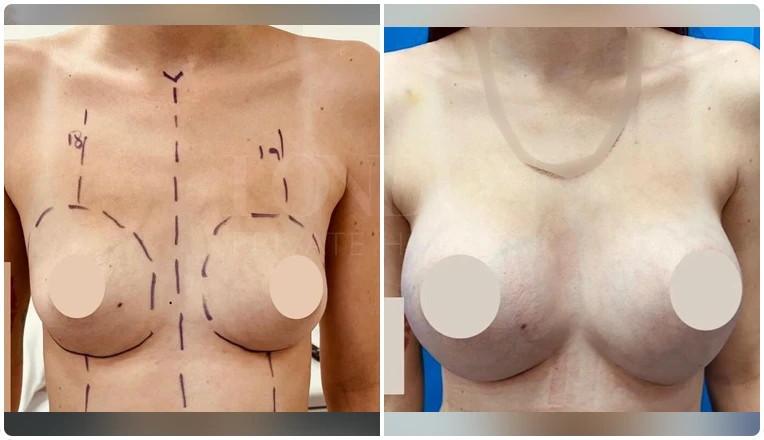 breast augmentation before and after patient-9