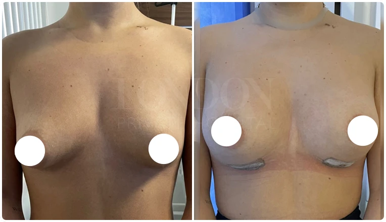 breast augmentation before and after patient