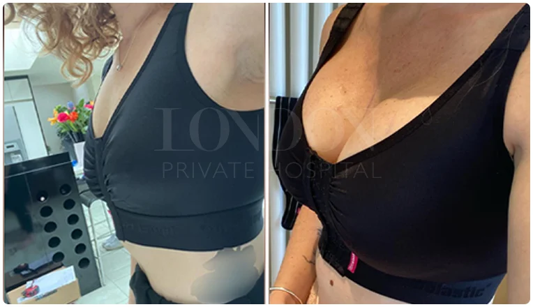 breast augmentation before and after result patient-10-v2