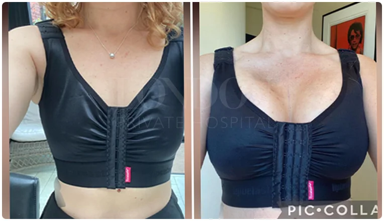 breast augmentation before and after result patient-10