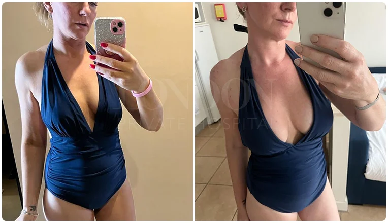 breast augmentation before and after result patient-4-v1