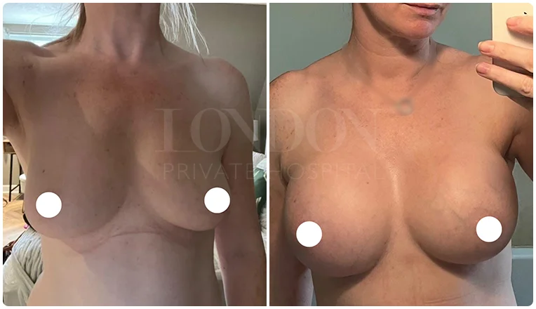 breast augmentation before and after result patient-4