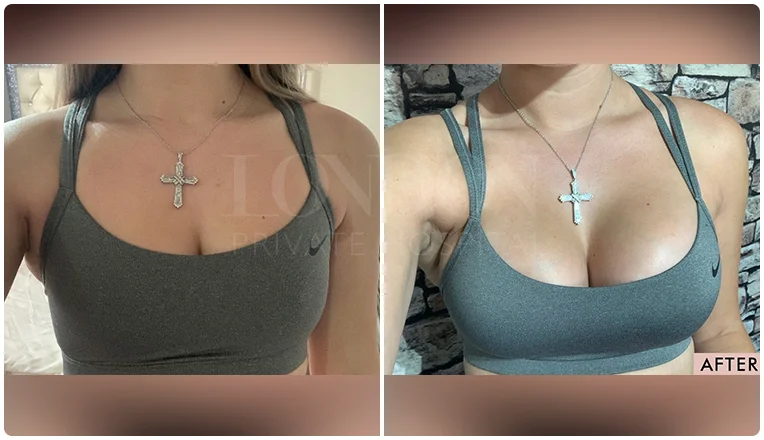 breast augmentation before and after result patient-5