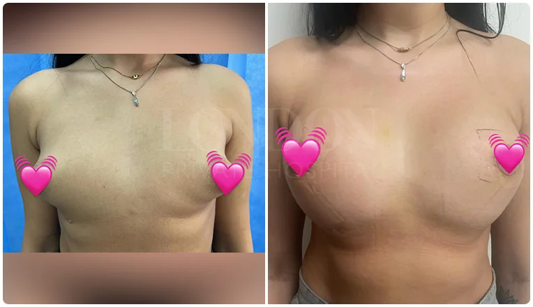 breast augmentation before and after result patient-7