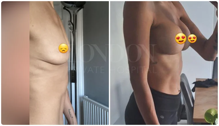 breast augmentation before and after result patient-8-v1