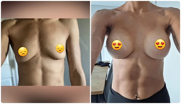 breast augmentation before and after result patient-8