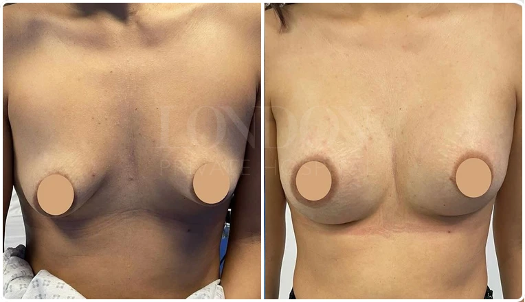 breast enlargement before and after patient-1