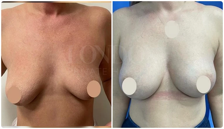 breast enlargement before and after patient-2