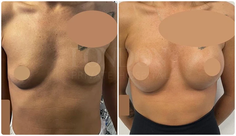 breast enlargement before and after patient-3