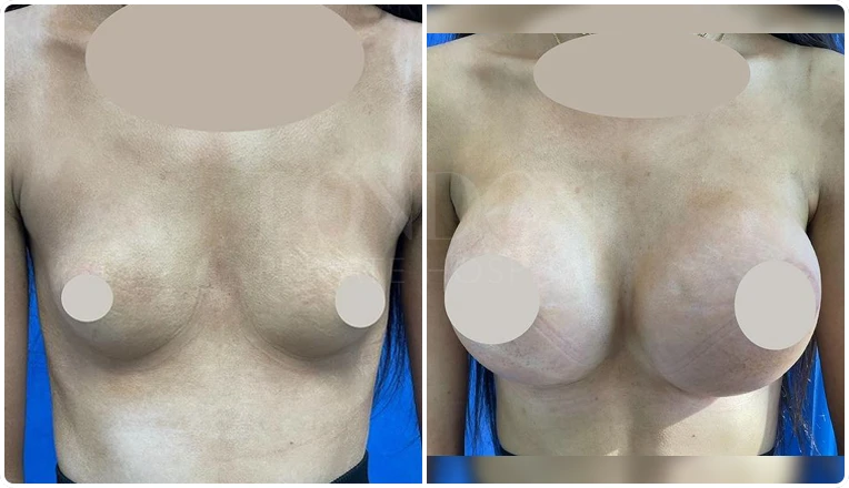 breast enlargement before and after patient-4-v1