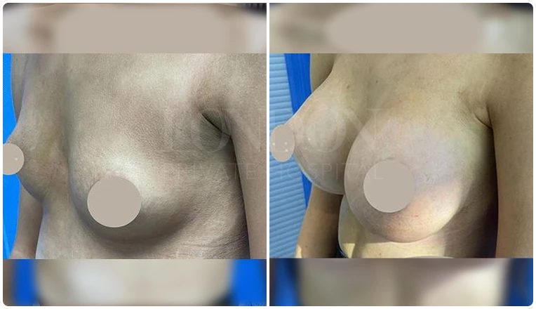 breast enlargement before and after patient-4-v2