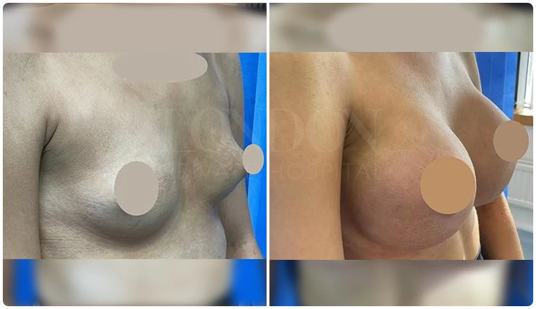 breast enlargement before and after patient-4