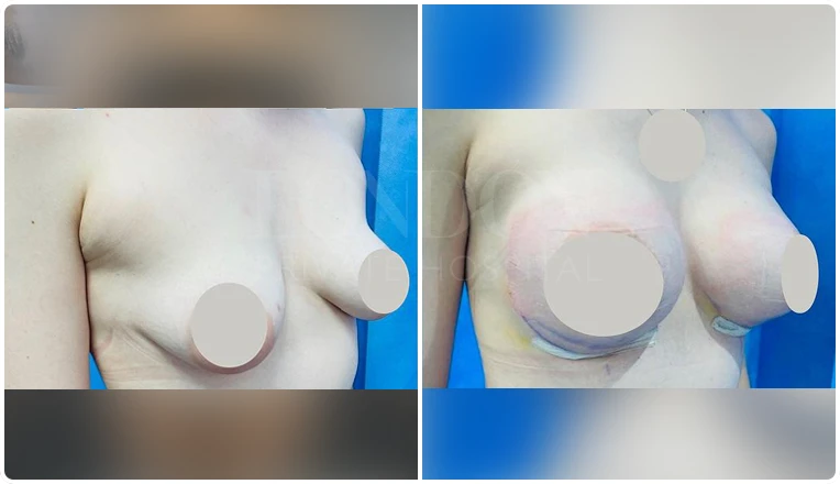 breast enlargement before and after patient-6-v1