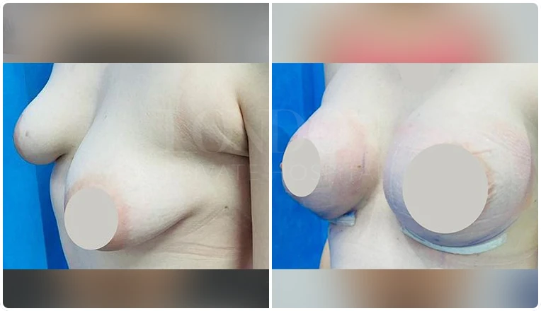 breast enlargement before and after patient-6-v2