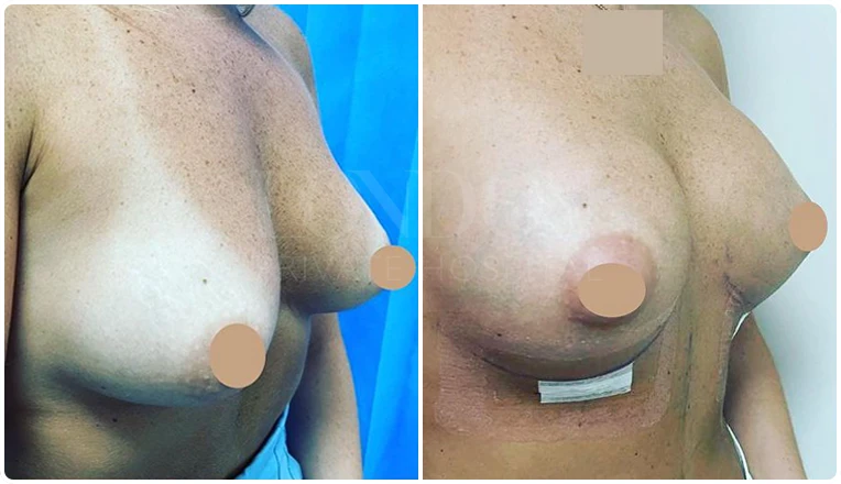 breast enlargement before and after patient-7-v1