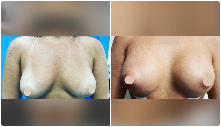 breast enlargement before and after patient-7-v2