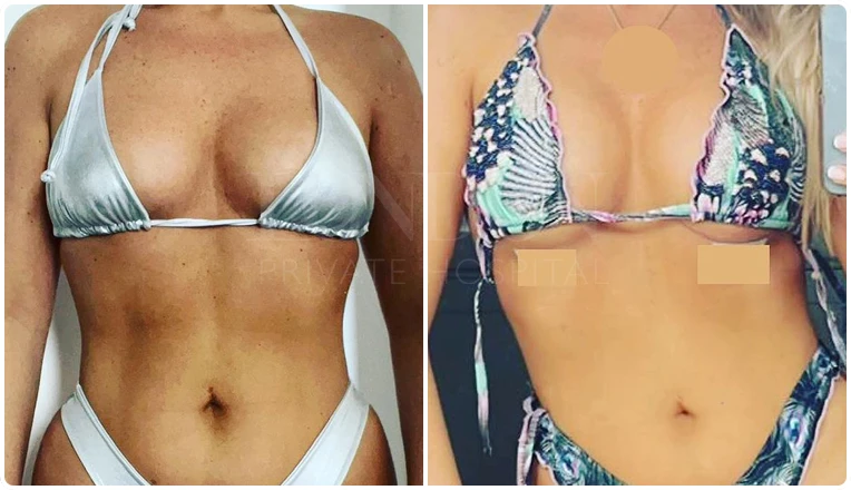 breast enlargement before and after patient-7-v3