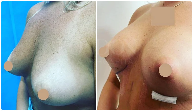 breast enlargement before and after patient-7