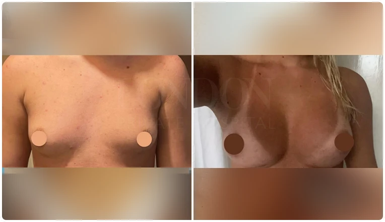 breast enlargement before and after patient-8