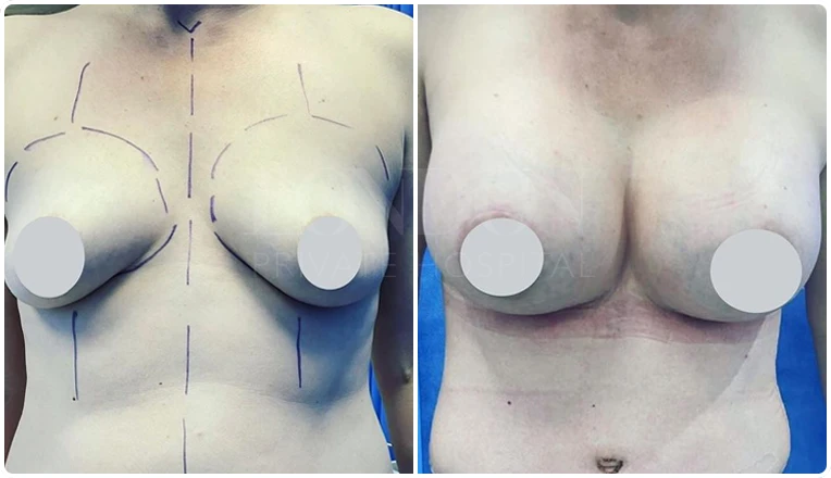 breast enlargement before and after patient