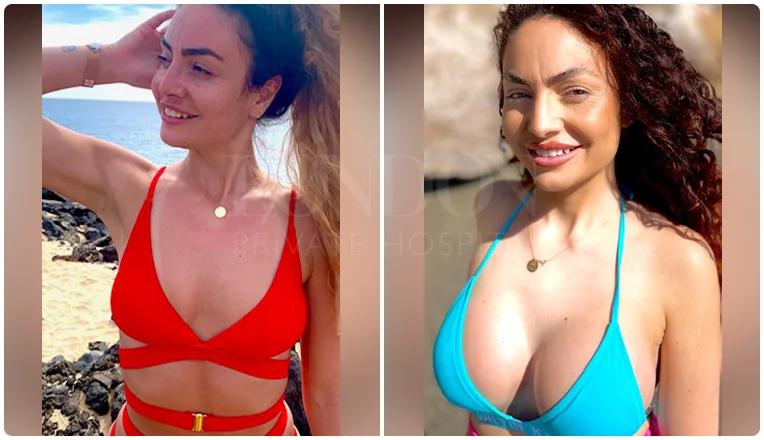 breast enlargement before and after result patient-12