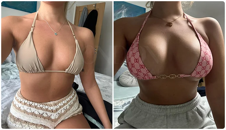 breast enlargement before and after result patient-16