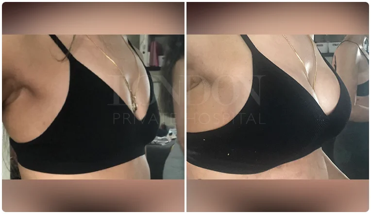 breast enlargement before and after result patient-5