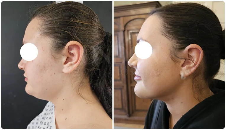 chin vaser liposuction before and after patient -1-v1