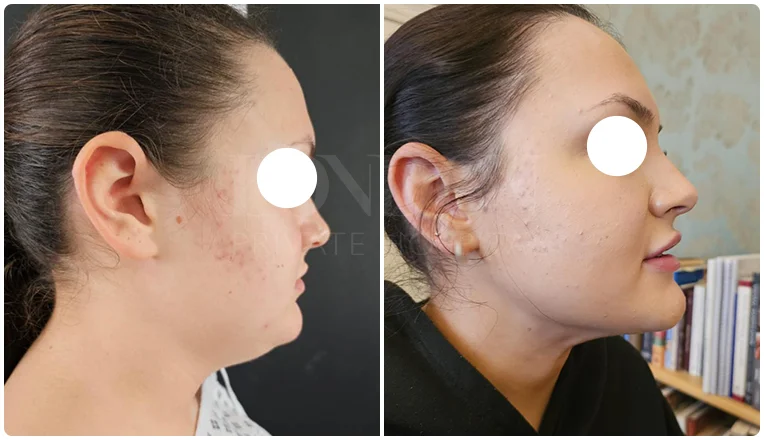 chin vaser liposuction before and after patient -1-v2