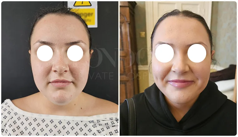 chin vaser liposuction before and after patient -1