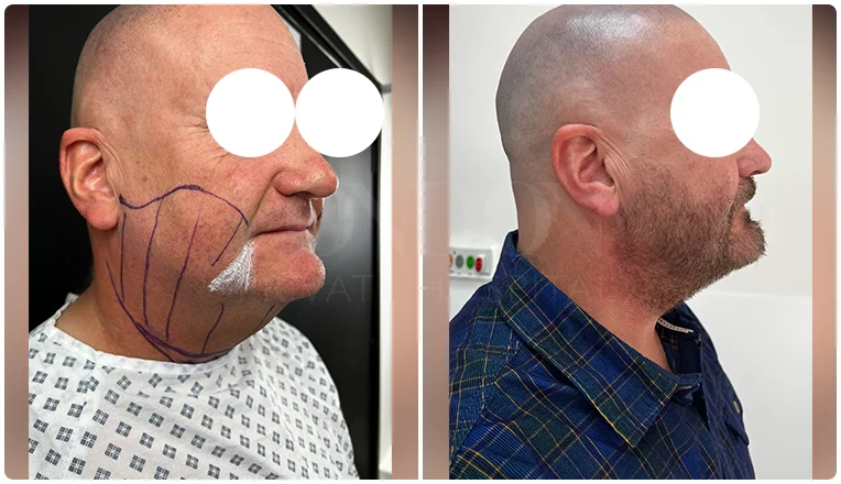 chin vaser liposuction before and after patient -13-v2